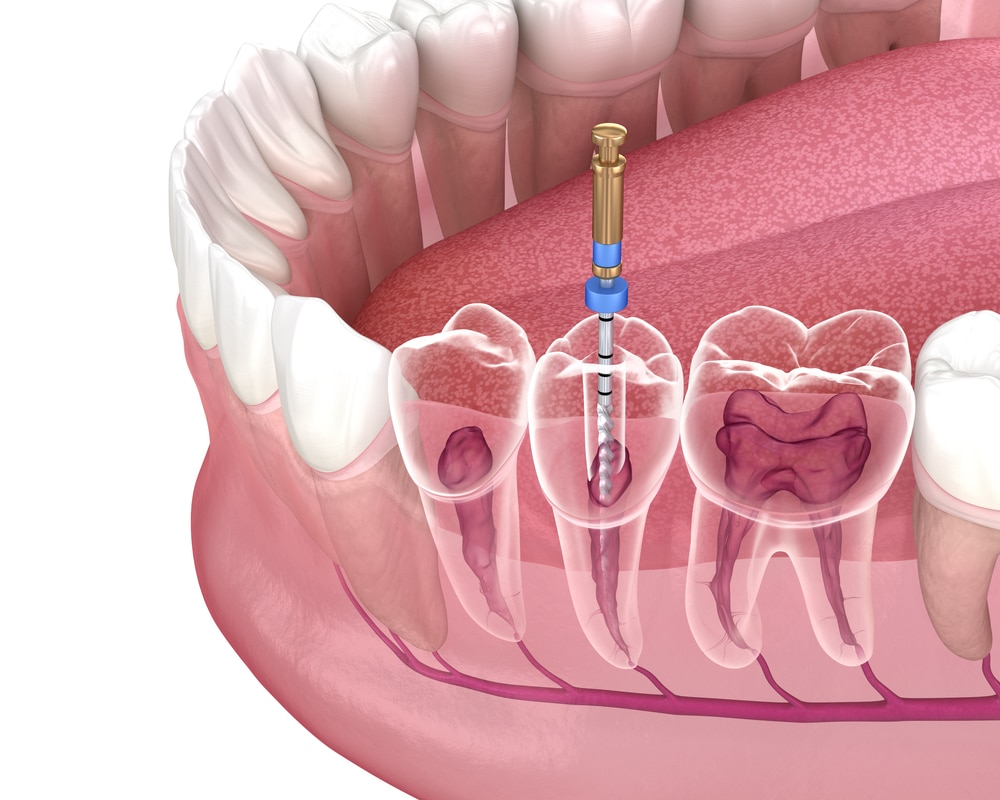Root Canal Therapy in Edmonton