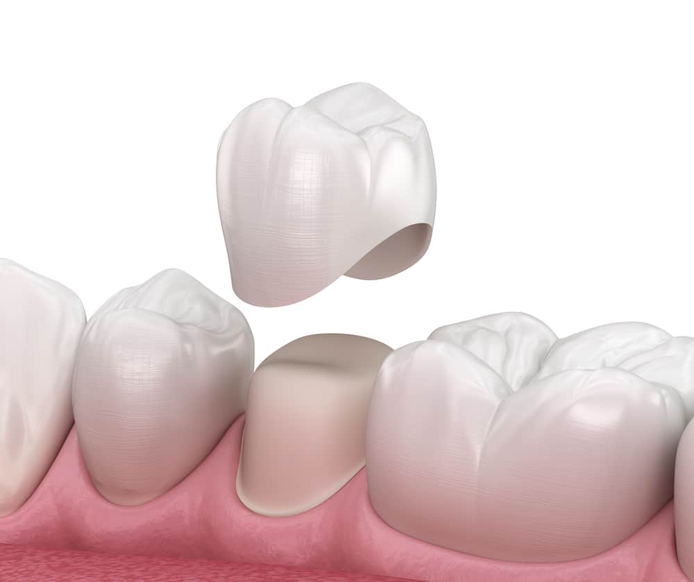 Dental Crowns in Edmonton