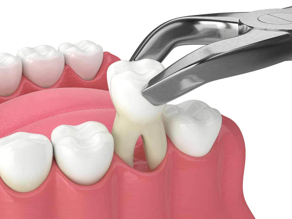 Tooth Extractions in Edmonton