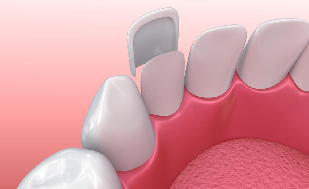 Porcelain Veneers in Edmonton
