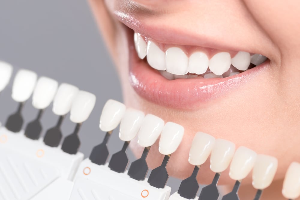 Teeth Whitening in Edmonton