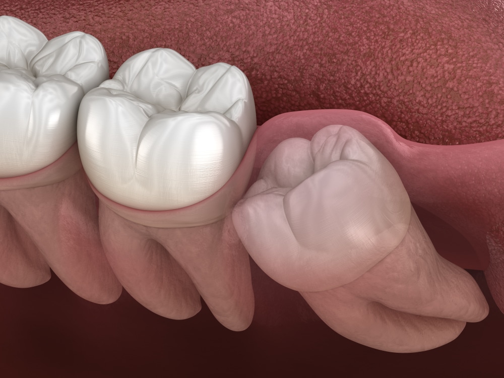 wisdom tooth removal edmonton