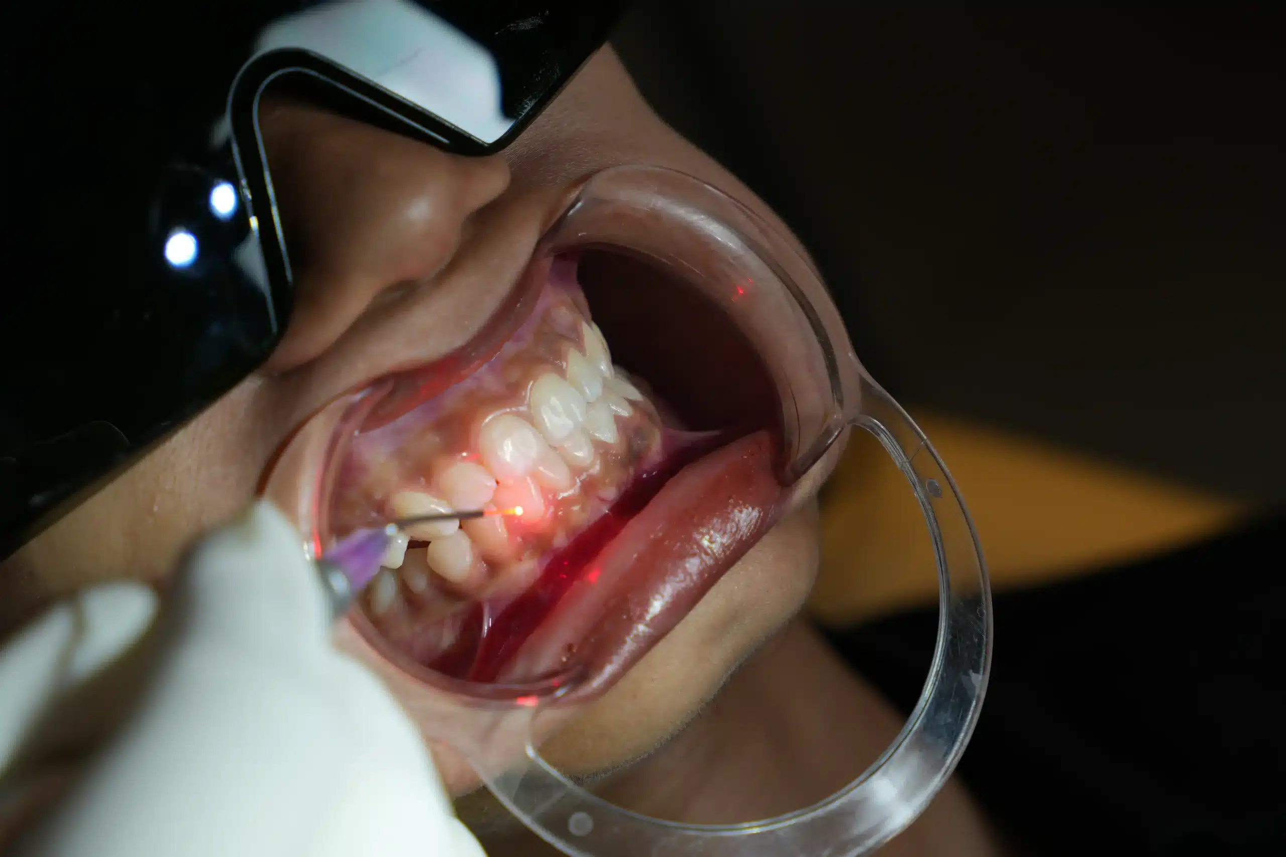 Dental professional using a laser device on a patient's gums while the patient wears protective laser safety glasses.